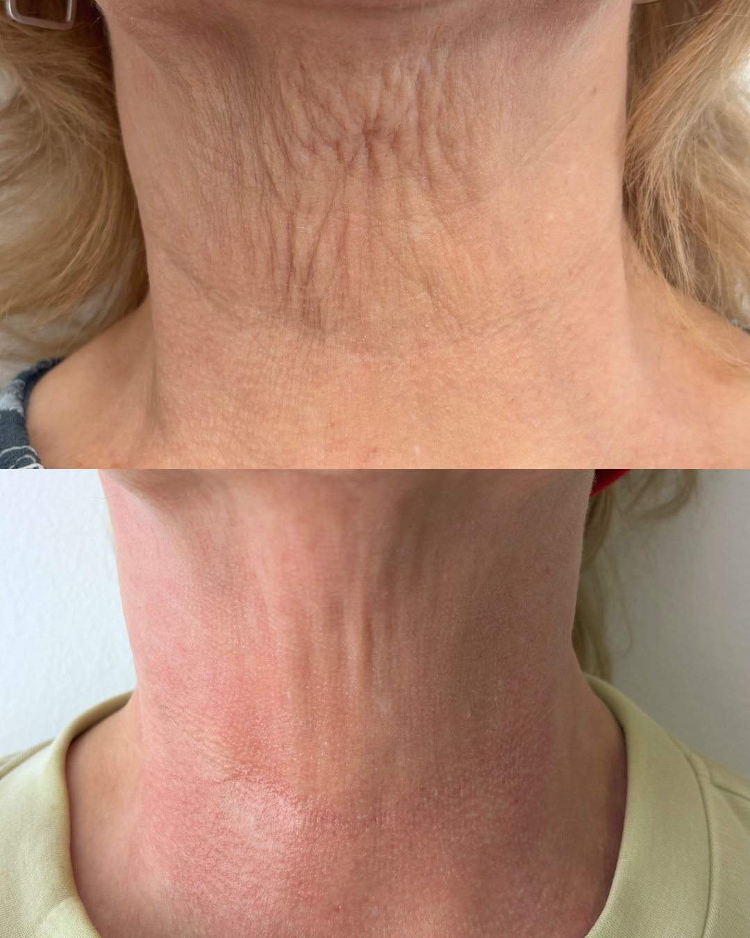 Before and after neck skin rejuvenation at FAM Clinic Cambridge